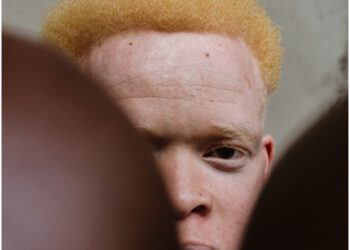 L’ALBINISME : DECONSTRUIRE LES MYTHES, PROMOUVOIR L’INCLUSION